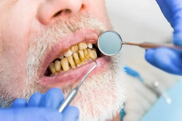 dentista y paciente consumidor de tabaco
