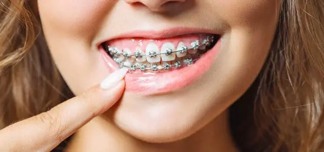 Sonrisa con brackets autoligables