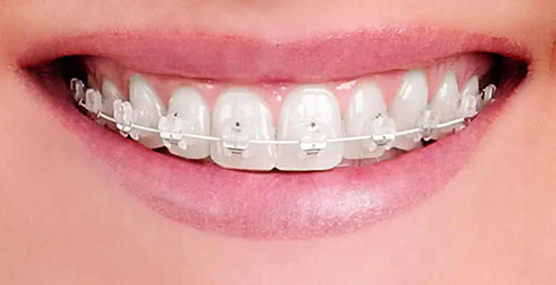 brackets autoligables