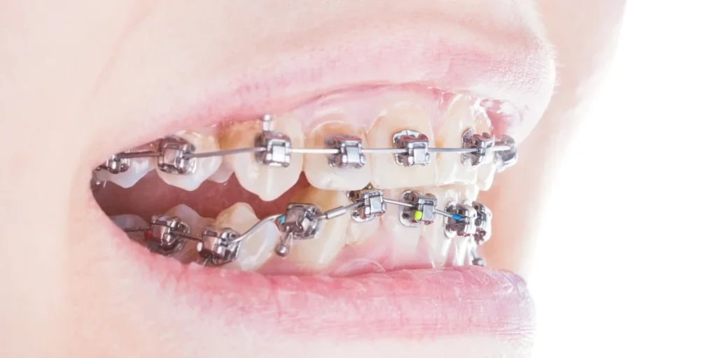 brackets autoligables