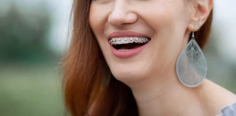 brackets de autoligado