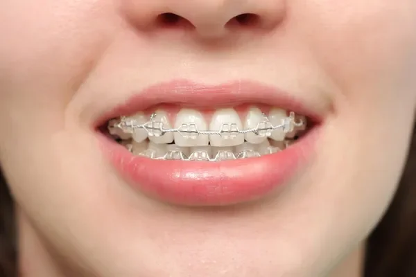 brackets invisibles