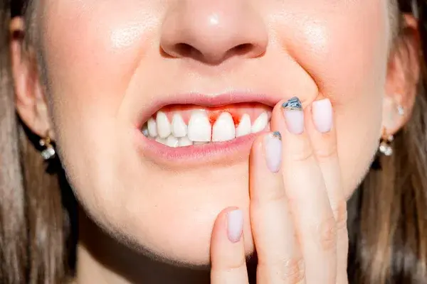 Cómo prevenir la gingivitis