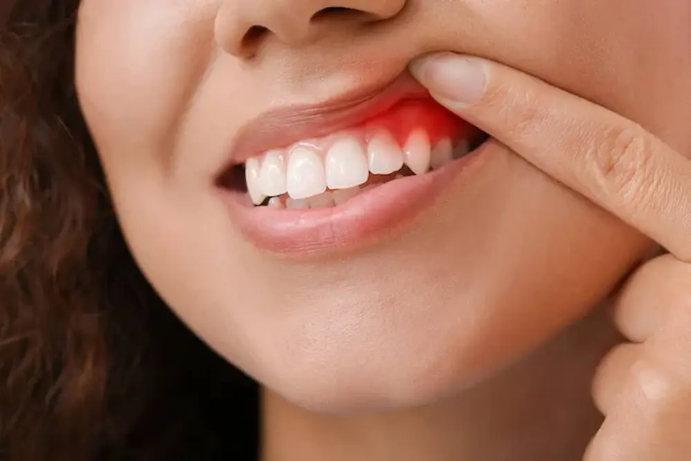 Gingivitis