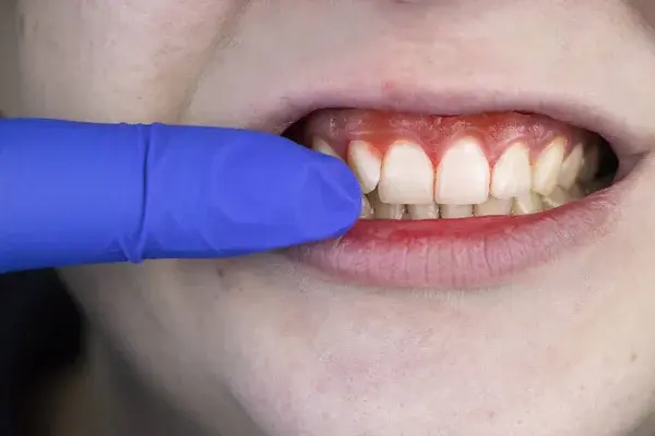 Qué es la gingivitis