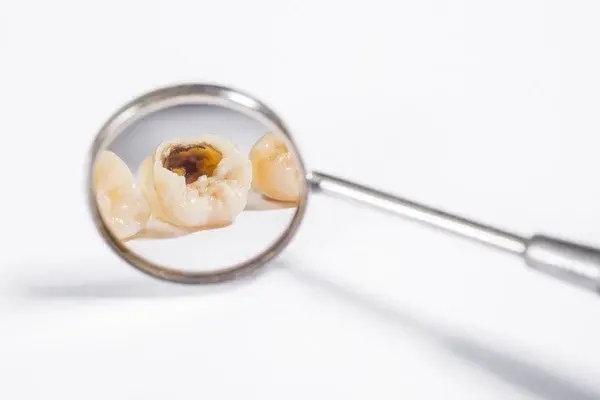 Qué es una caries