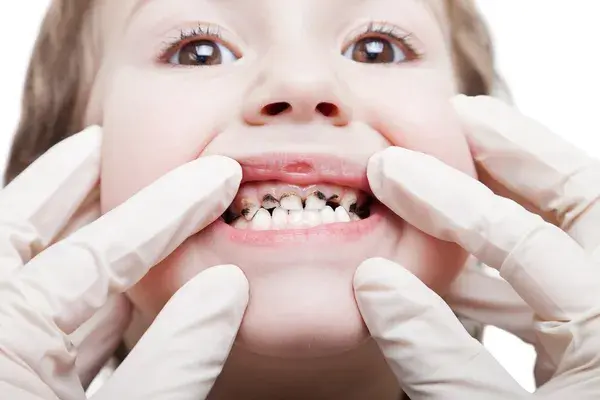 Tipos de caries infantil