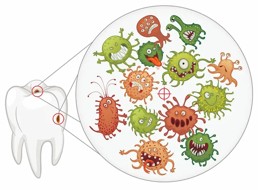 5 Tipos de caries