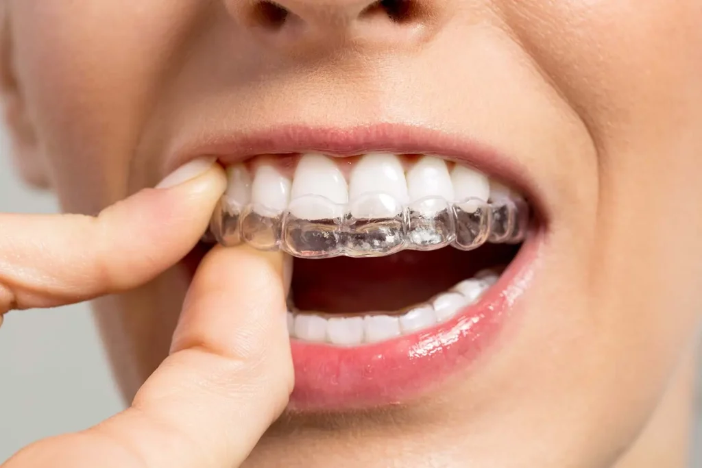 es posible enderezar los dientes a cuakquier edad