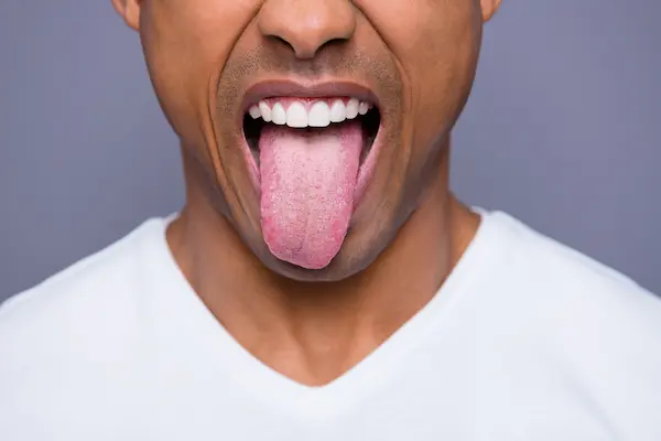 causas de la lengua blanca