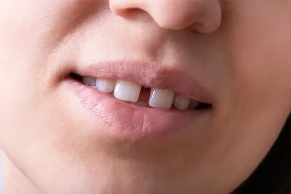 causas más comunes de la diastema