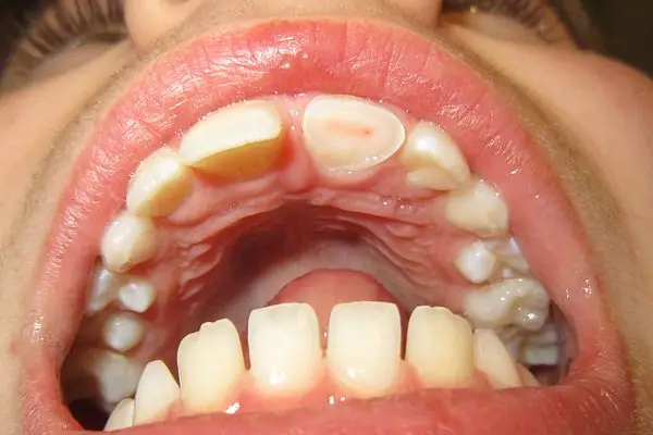 10 principales causas del nervio dental