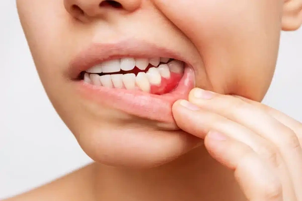 10 síntomas de la periodontitis que debes saber