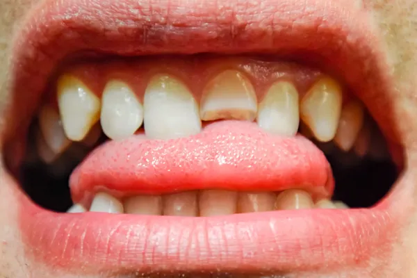 7 causas de los dientes astillados