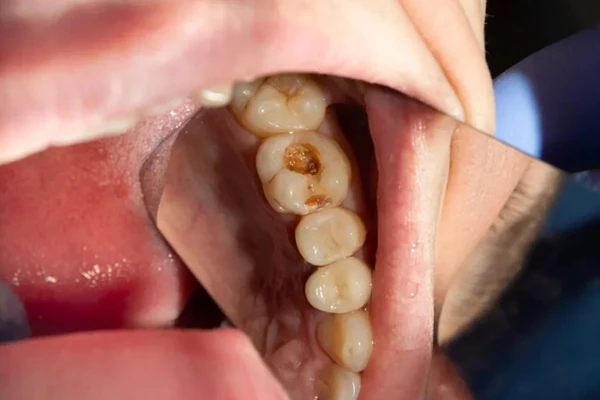 7 tipos de fisuras dentales