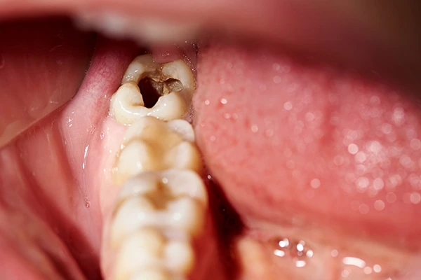 Qué son las fisuras dentales y por qué aparecen