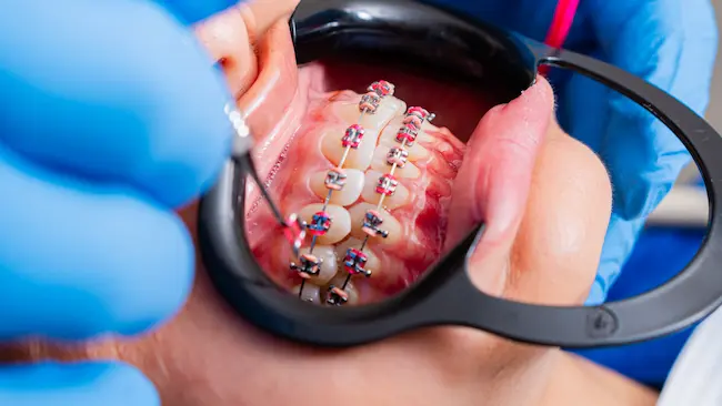 Cómo cuidar los colores de liga de los brackets