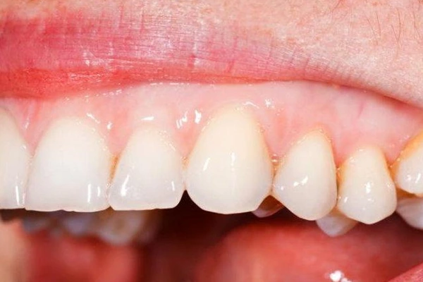 10 causas de las encías blancas