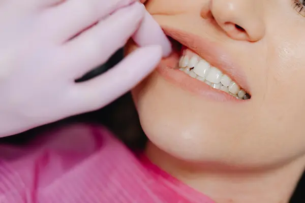 Tipos de fractura dental