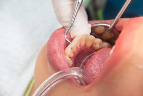 Por qué realizar un destartraje dental