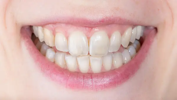 10 causas de los dientes transparentes en las puntas