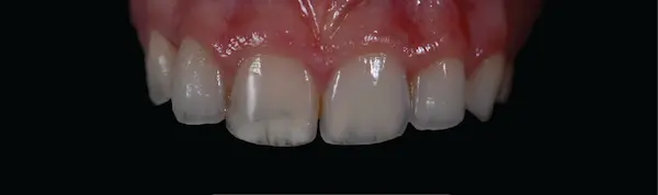 Cómo saber si los dientes transparentes en las puntas están avanzando