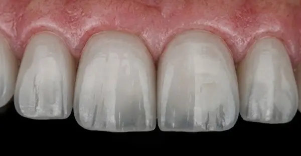 Es normal que las puntas de los dientes se vean transparentes