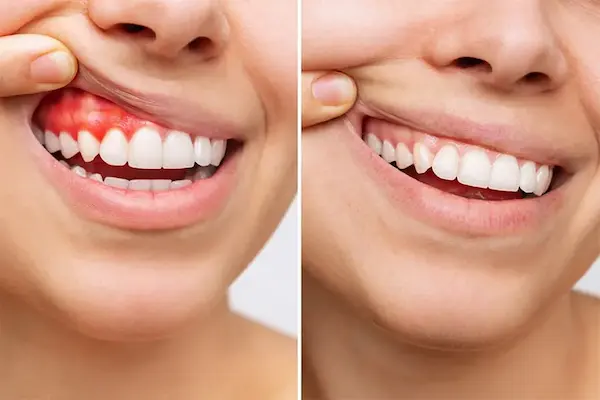 Inflamación y cambios en las encías