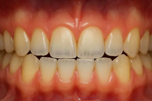 Rechinar o apretar los dientes