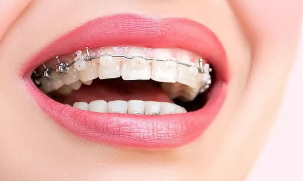 brackets autoligables comodidad