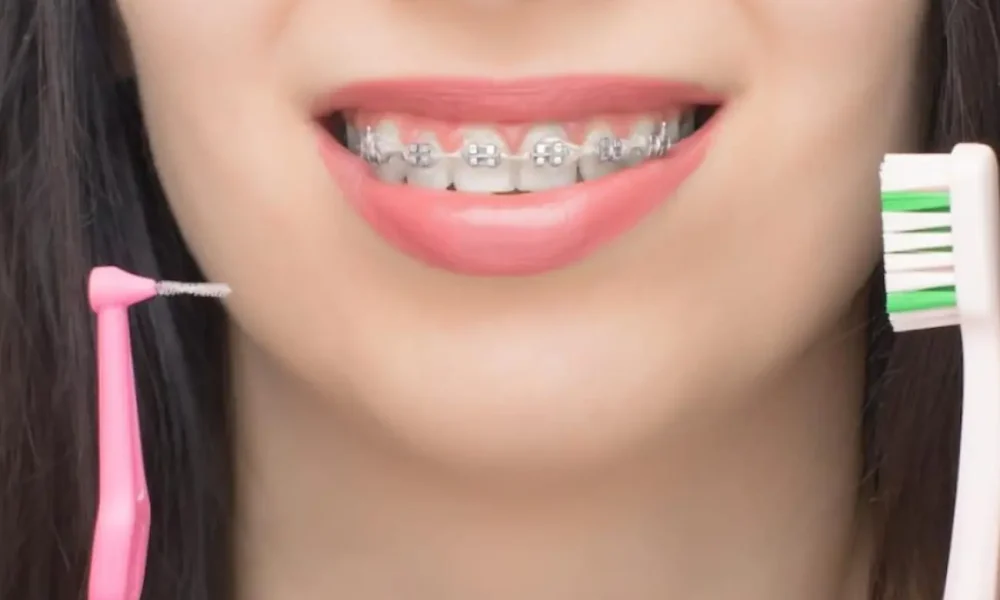 brackets autoligables mejor higiene