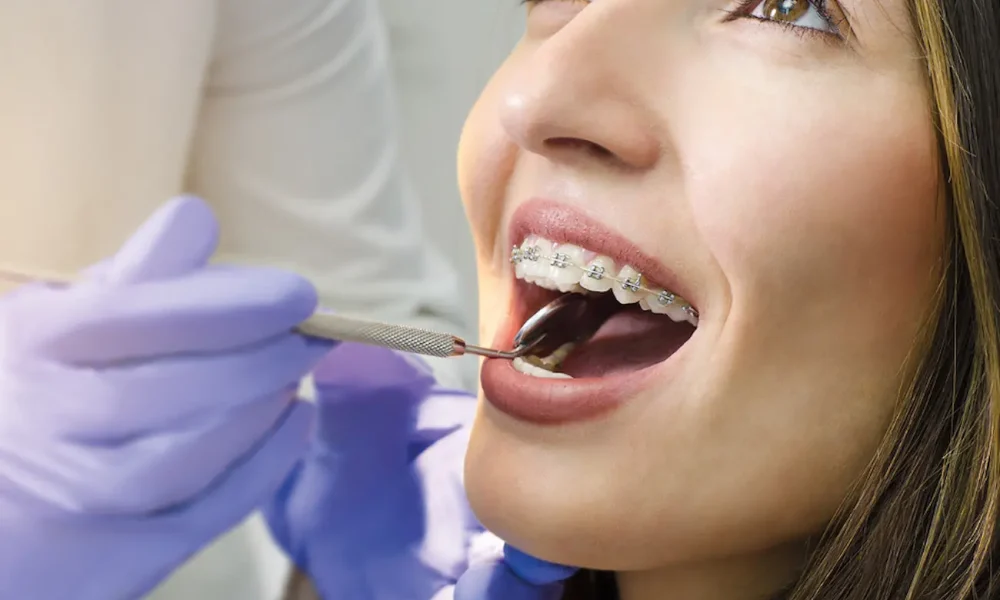 brackets autoligables tratamiento
