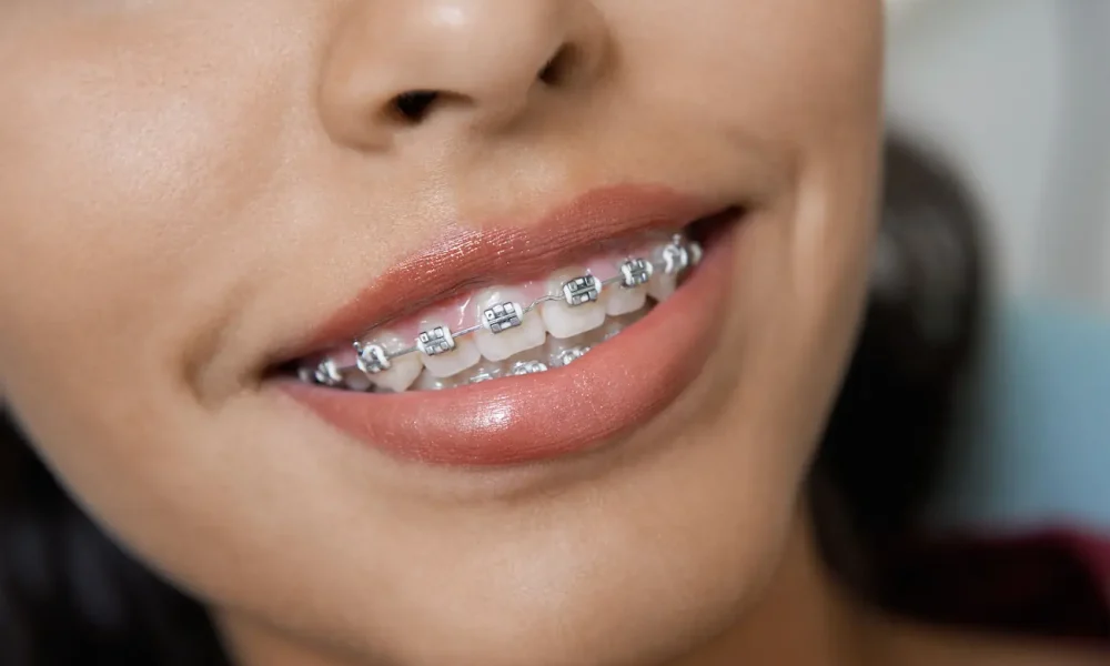 brackets transparentes comodidad