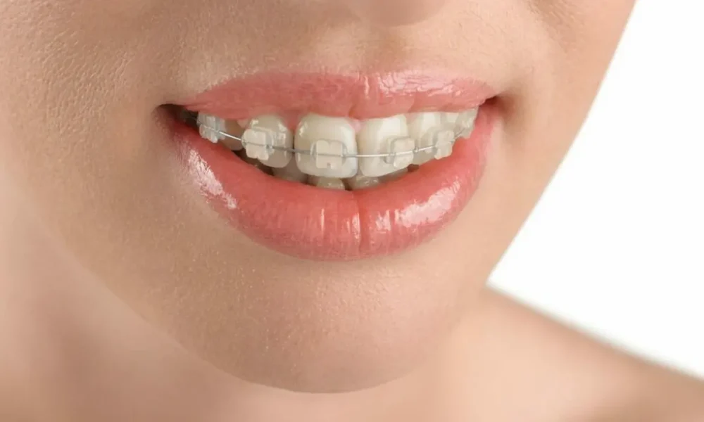 brackets transparentes estetica