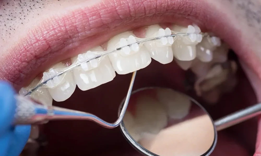 brackets transparentes tratamiento